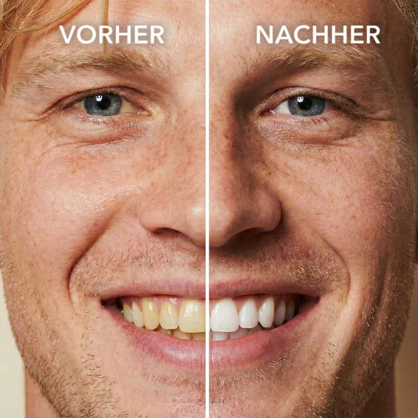 SootheTouch™ Tooth Whitening - Instant Clean Smile
